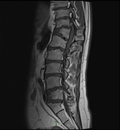 Morquio syndrome | Radiology Reference Article | Radiopaedia.org