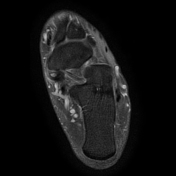 Accessory navicular syndrome | Radiology Reference Article ...