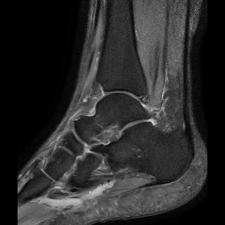 Os tibiale externum | Image | Radiopaedia.org