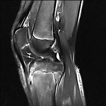 Salter-Harris type II fracture - proximal tibia | Radiology Case ...