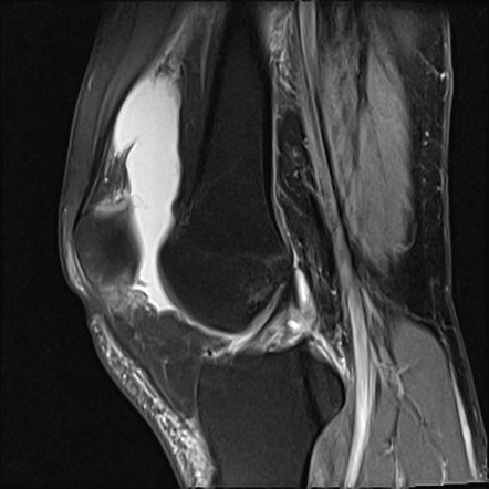 Trochlear dysplasia | Image | Radiopaedia.org