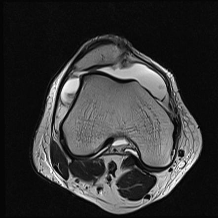 Trochlear dysplasia | Image | Radiopaedia.org