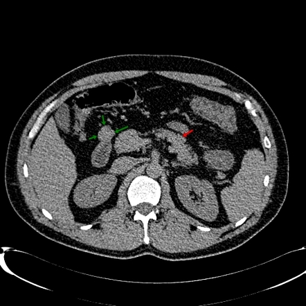 Ectopic pancreatic tissue | Image | Radiopaedia.org