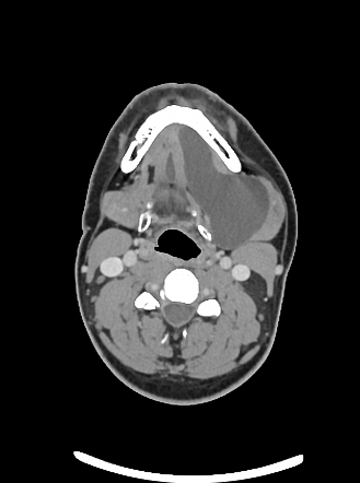 Ranula | Radiology Case | Radiopaedia.org