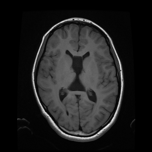 Cavum septum pellucidum et vergae cyst | Image | Radiopaedia.org