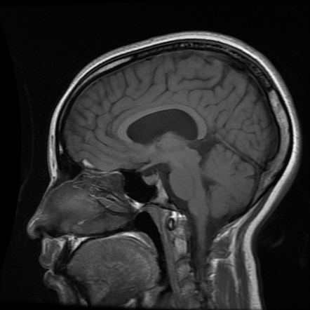 Cavum septum pellucidum et vergae cyst | Image | Radiopaedia.org