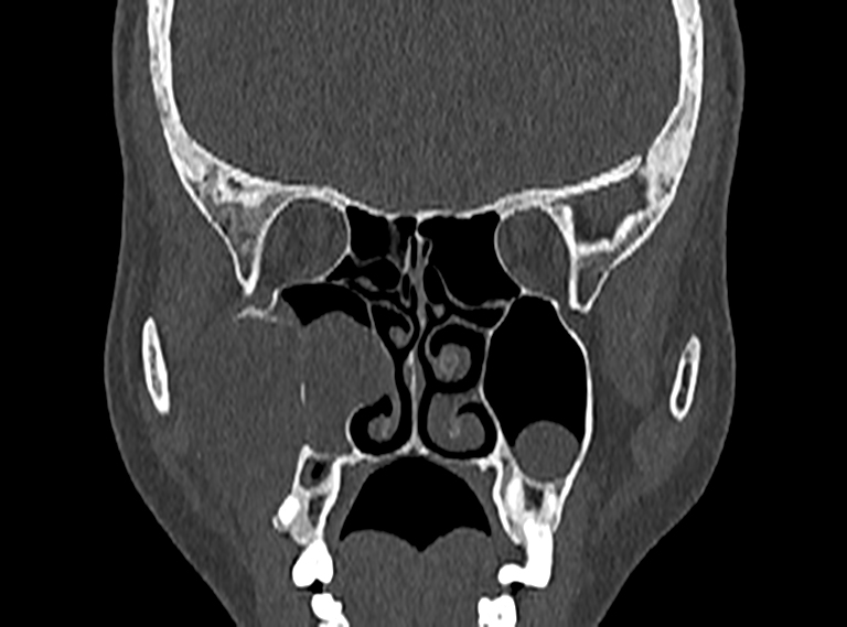 Dentigerous cyst | Image | Radiopaedia.org