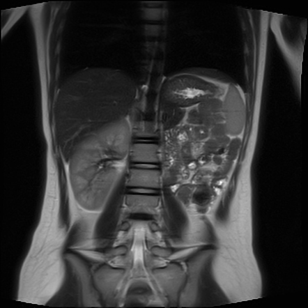 Herlyn-Werner-Wunderlich Syndrome | Image | Radiopaedia.org