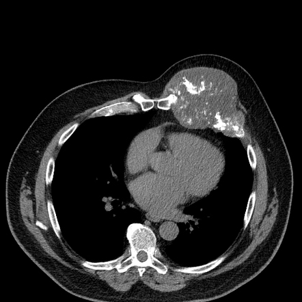 Chondrosarcoma of rib | Radiology Case | Radiopaedia.org