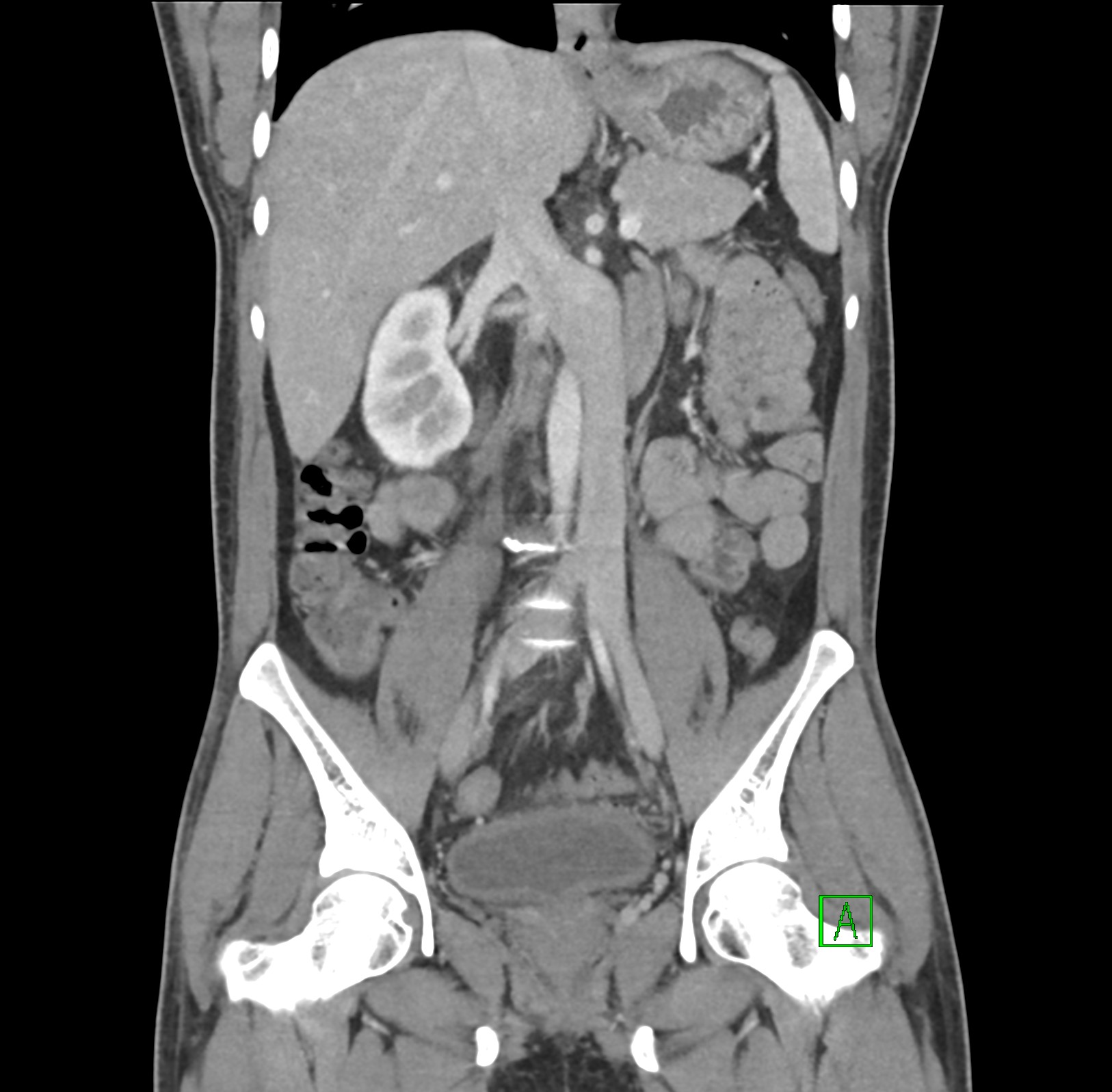 Transposition of inferior vena cava | Image | Radiopaedia.org