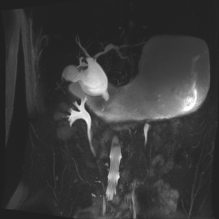 Choledochal Cyst Image