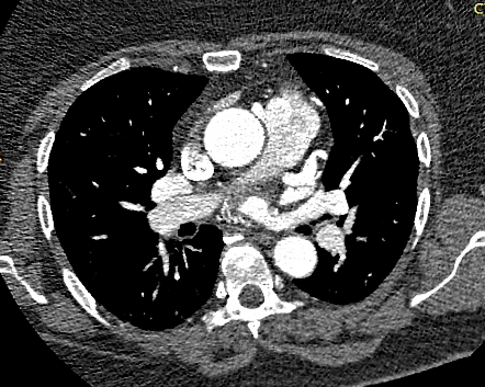 Anomalous right coronary artery from the pulmonary artery | Radiology ...