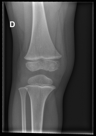 Epiphyseal cortical irregularity | Radiology Case | Radiopaedia.org