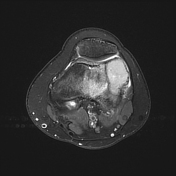 Phase-encoded motion artifact | Radiology Reference Article ...