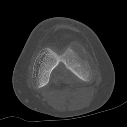 Giant cell tumor of bone | Image | Radiopaedia.org