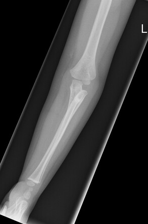 Proximal Radioulnar Synostosis | Radiology Case | Radiopaedia.org