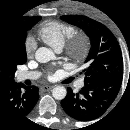 Anomalous right coronary artery from left coronary sinus | Radiology ...