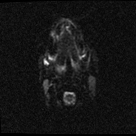 Myelin oligodendrocyte glycoprotein antibody-associated disease (MOGAD ...