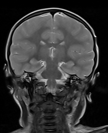 Diffuse cerebral edema | Image | Radiopaedia.org