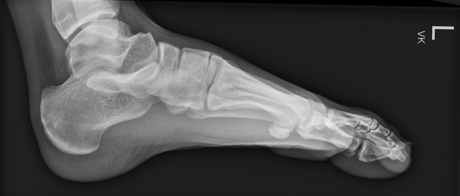 Symphalangism of fifth toe with intra-articular fracture | Image ...