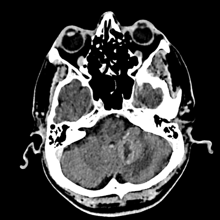 Cerebellar metastasis | Radiology Case | Radiopaedia.org