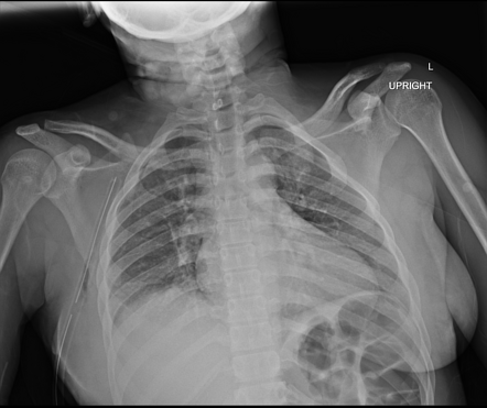 Chest tube in axilla | Radiology Case | Radiopaedia.org