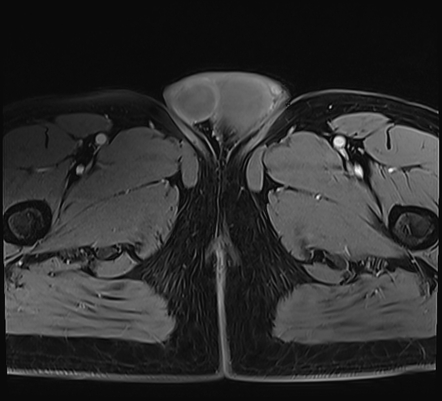 Testicular torsion | Image | Radiopaedia.org