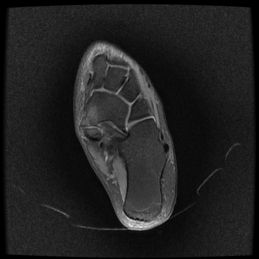 Accessory Navicular Syndrome Image