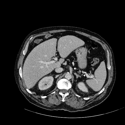 Meckel diverticulitis | Image | Radiopaedia.org