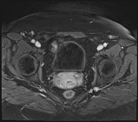 Deep pelvic endometriosis | Image | Radiopaedia.org