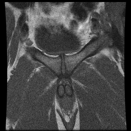 Penile fracture | Image | Radiopaedia.org