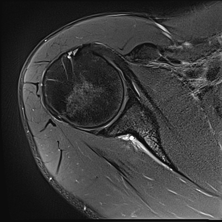 Unstable os acromiale | Radiology Case | Radiopaedia.org