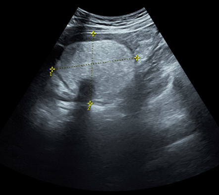 Ovarian dermoid complicated by ovarian torsion | Image | Radiopaedia.org