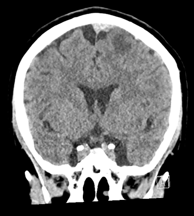 Venous infarct due to superior sagittal sinus and superior cortical ...