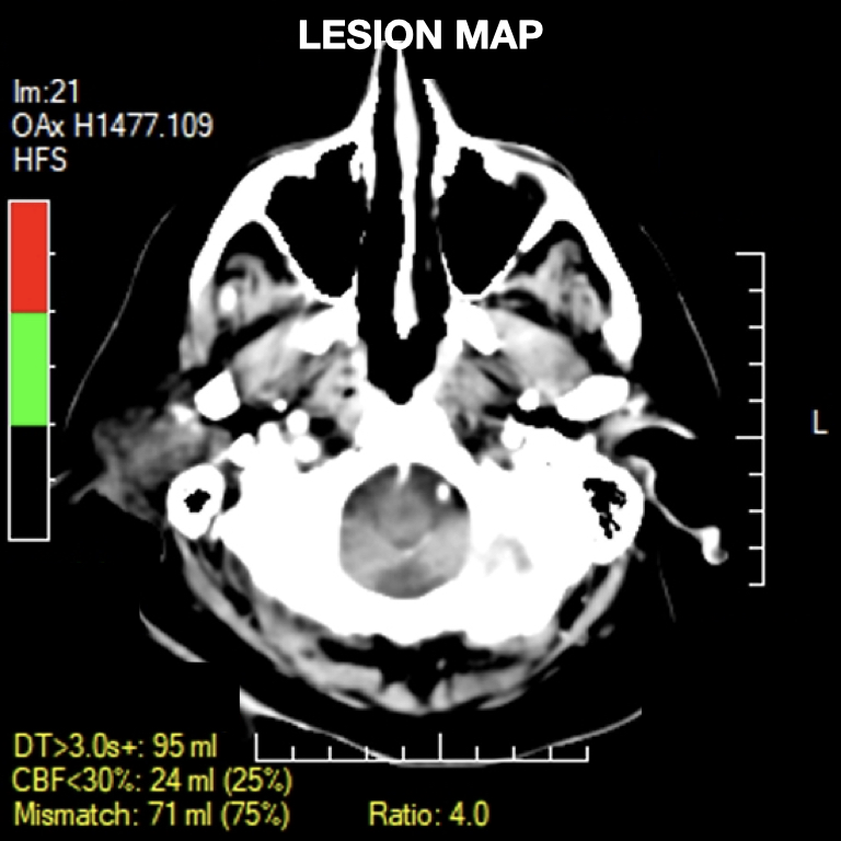 Bilateral Aca Infarction Due To Azygos Aca Embolism 