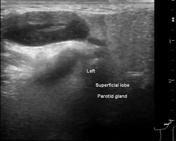 Intraparotid lymph nodes | Radiology Reference Article | Radiopaedia.org