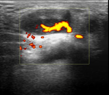 Enlarged Parotid Lymph Node Image Radiopaedia Org