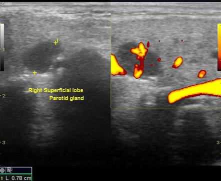 Enlarged Parotid Lymph Node Image Radiopaedia Org