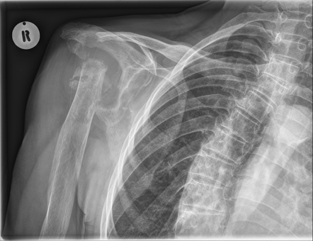 Milwaukee shoulder | Radiology Case | Radiopaedia.org