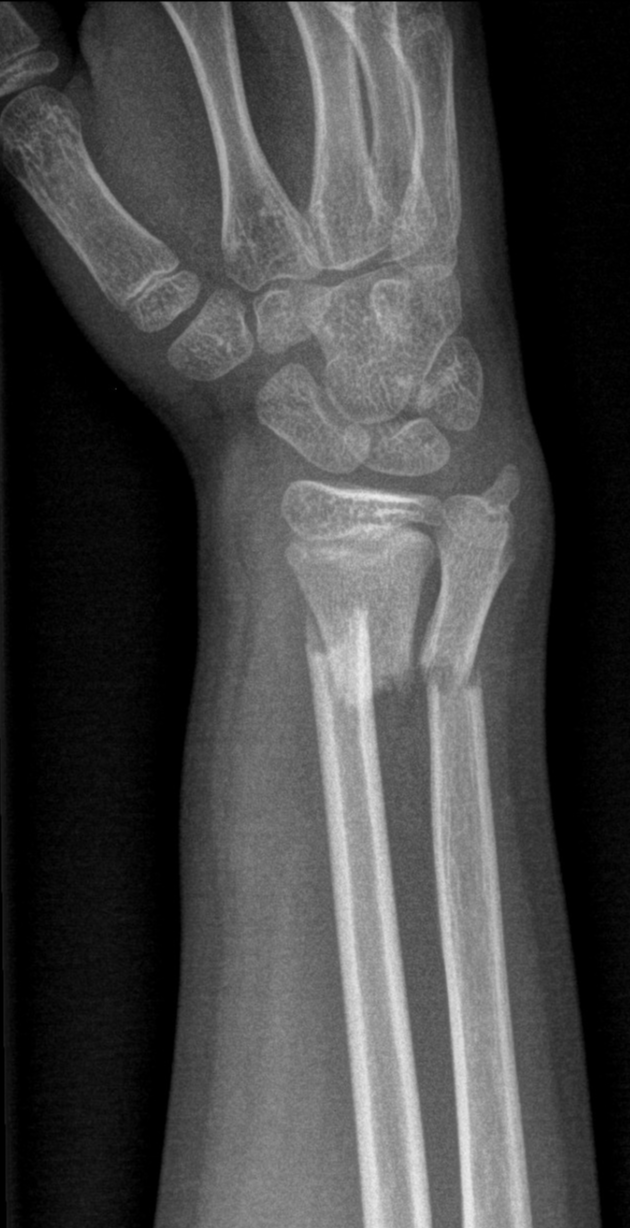 Colles fracture - dinner fork deformity | Image | Radiopaedia.org