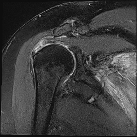 Infraspinatus tendon tear | Radiology Reference Article | Radiopaedia.org