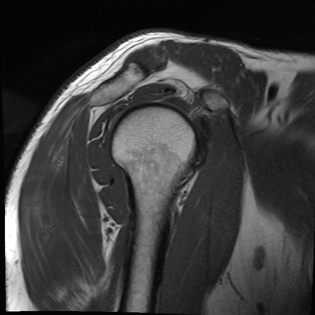 Rim Rent Tear Of The Supraspinatus Tendon Image Radiopaedia Org