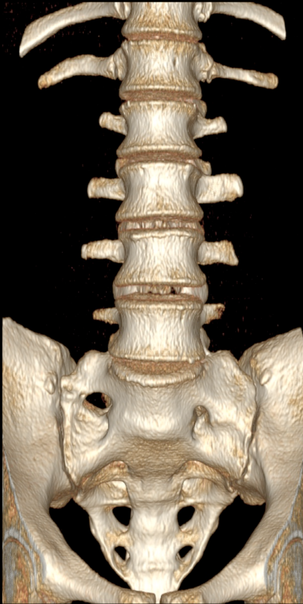 Conjoined L5 and S1 nerve roots | Image | Radiopaedia.org