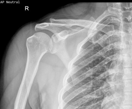 Supraspinatus calcific tendinosis | Radiology Case | Radiopaedia.org