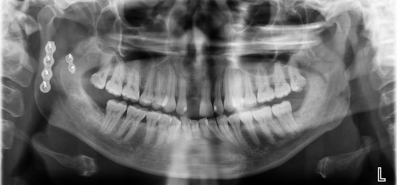 Mandibular fractures | Image | Radiopaedia.org