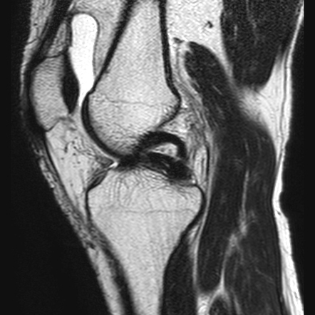 icd 10 code for right knee bucket handle medial meniscus tear