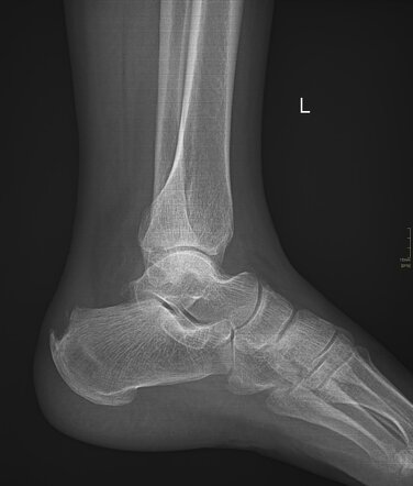 Achilles insertional tendinosis | Radiology Case | Radiopaedia.org