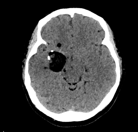 Ruptured intracranial dermoid | Image | Radiopaedia.org