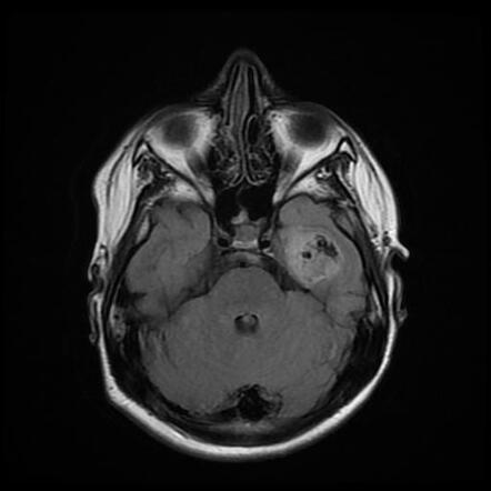 Polymorphous low grade neuroepithelial tumor of the young (PLNTY ...