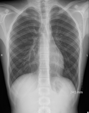 Pectus excavatum | Radiology Reference Article | Radiopaedia.org